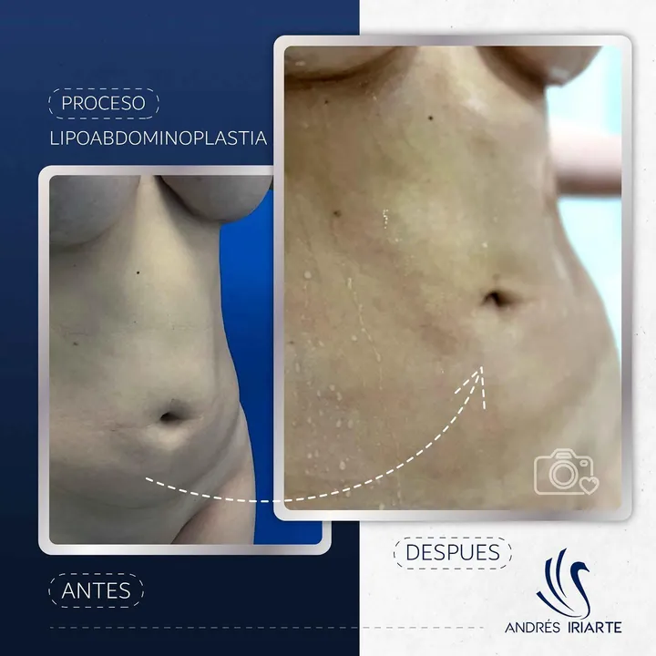 Antes y después de lipoabdominoplastia, acercamiento del abdomen