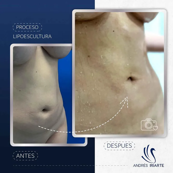 Antes y después de lipoescultura, acercamiento del abdomen
