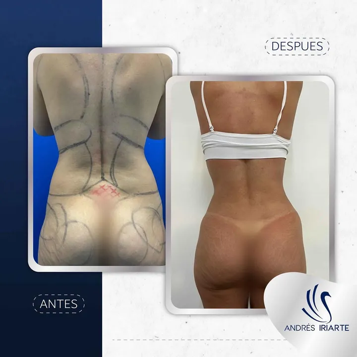 Antes y después de lipoescultura, vista posterior de espalda y cintura