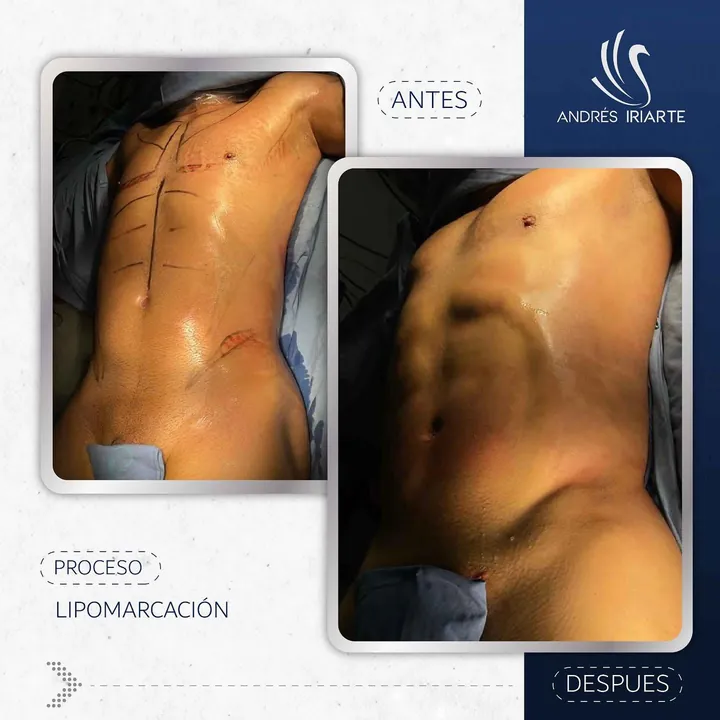 Antes y después de lipomarcación abdominal en un paciente hombre