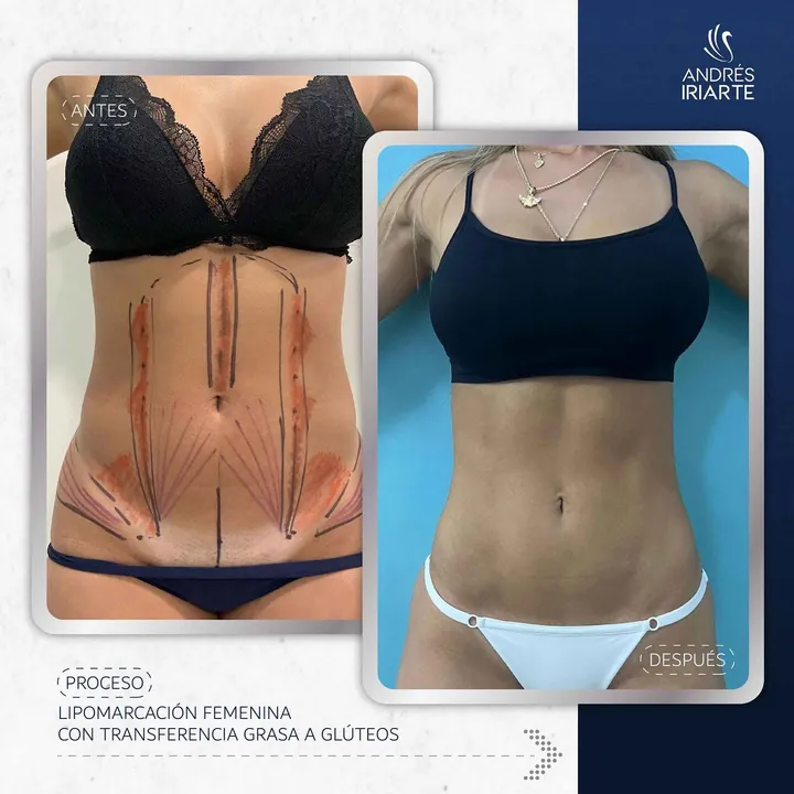 Antes y después de lipomarcación femenina con transferencia grasa a glúteos, vista frontal del abdomen