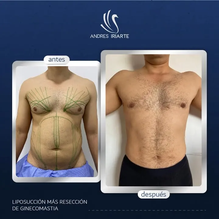 Antes y después de liposucción y resección de ginecomastia en el tórax de un paciente hombre