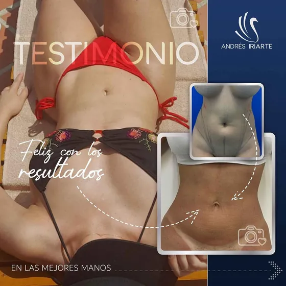 Testimonio de una paciente feliz con los resultados en su abdomen