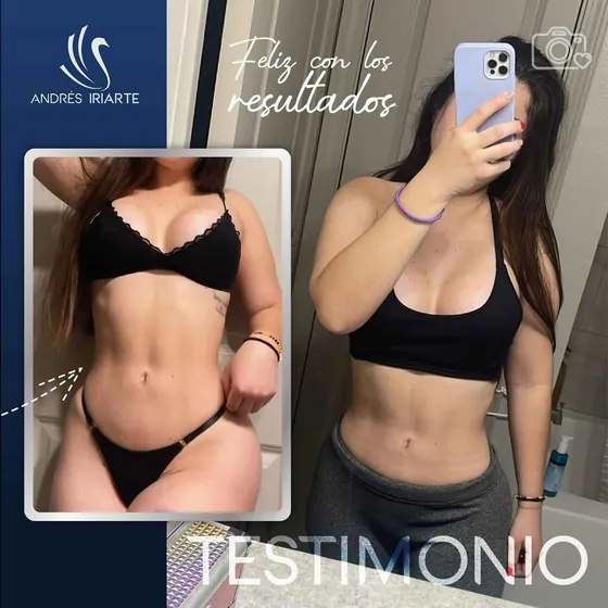 Testimonio de una paciente feliz con sus resultados, con fotografía de su abdomen antes y después