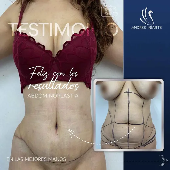 Testimonio de una paciente de abdominoplastia feliz con sus resultados