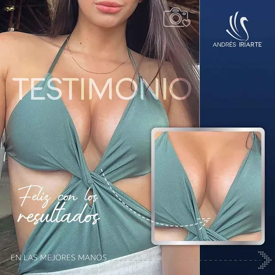 Testimonio de una paciente de aumento mamario feliz con sus resultados