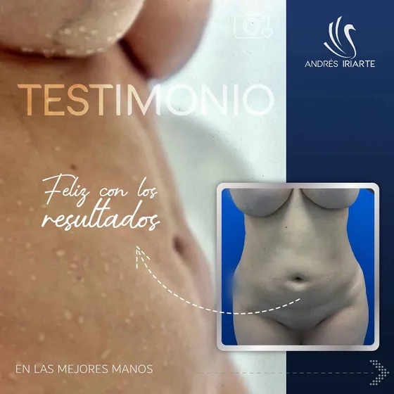 Testimonio de una paciente de lipoescultura feliz con sus resultados